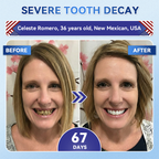 Glimmerly® 🦷 Tideglusib Fast‑Dissolving Tooth & Gum Repair Oral Strips